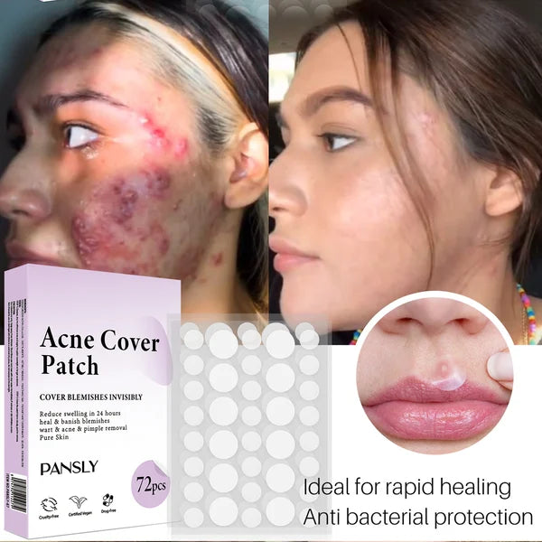 ✨ 2024 Hydrocolloid Acne Cover Patches(🔥Buy 3 Get 3 Free)