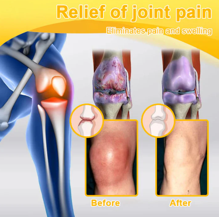 🎁Flash Sale - Botulinum Toxin & Bee Venom Pain-Relief Bone Healing Cream 🐝💎