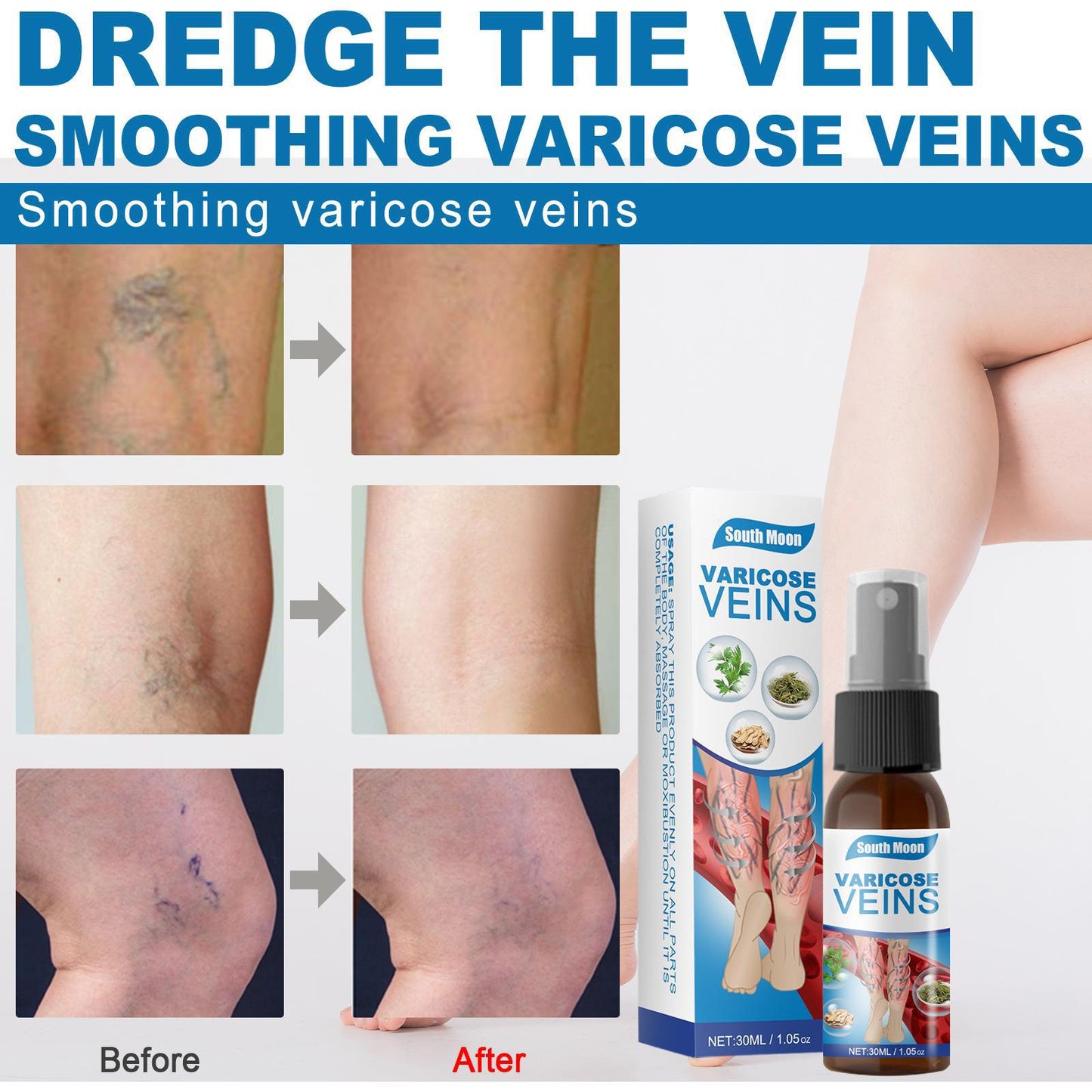 Varicose Veins Treatment Spray