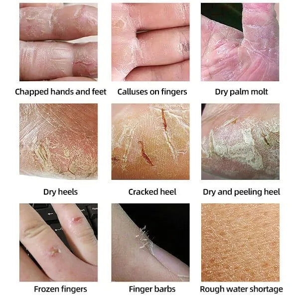 Foot Cream Anti-cracking Moisturizing Foot and Hand Cream Beauty đ„BUY 2 GET 1 FREE