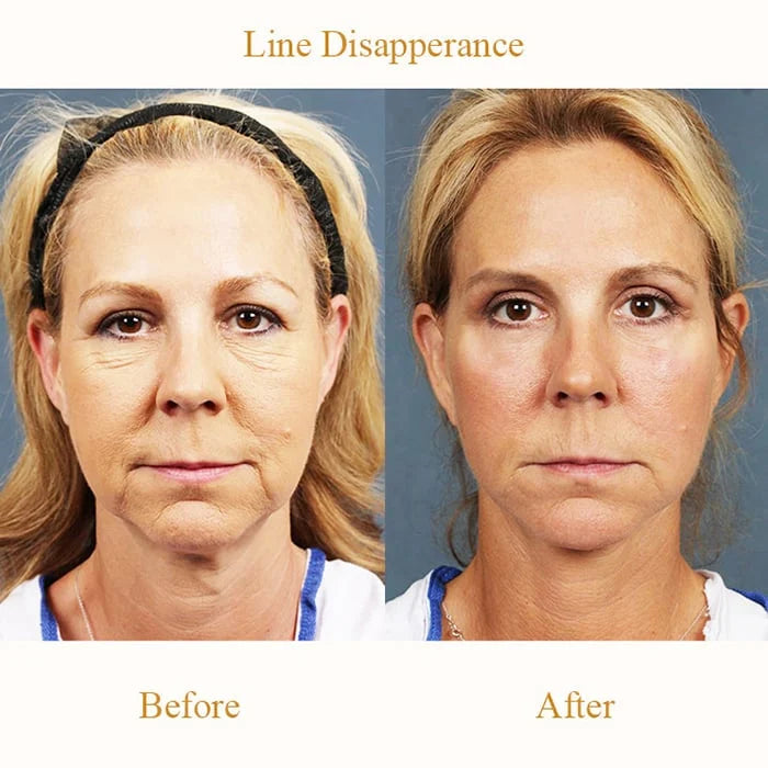 đ„Great Dealsđ - Protein Thread Lifting Set