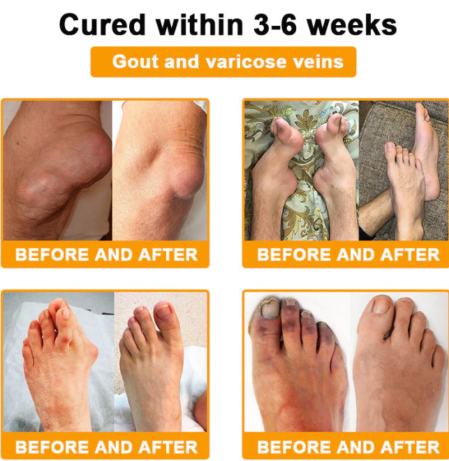 🎁Flash Sale - Botulinum Toxin & Bee Venom Pain-Relief Bone Healing Cream 🐝💎