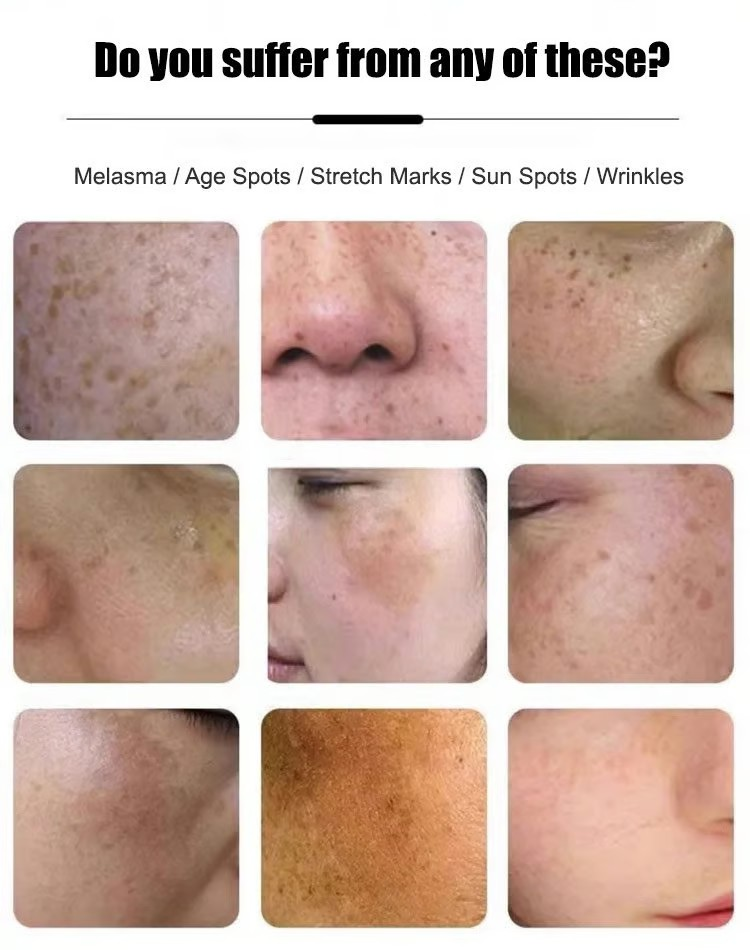 💥BIG DISCOUNT TODAY - 2025 NEW ANTI-BLEMISH & ANTI-AGING & ANTI-WRINKLE TEAR-OFF MASK (CLINICALLY CERTIFIED)