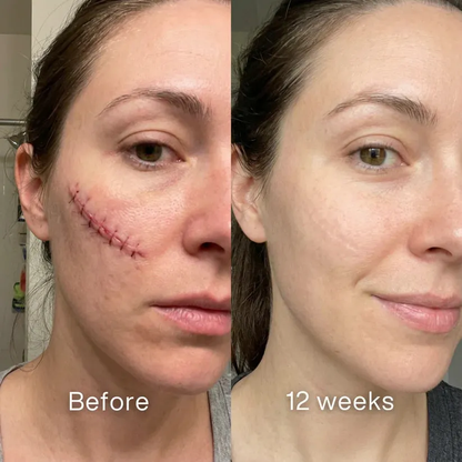 ODALIT™ Silicon ScarStick Limited Time 75%OFF Buy 2 Get 1 Free🔥LAST DAY⏰