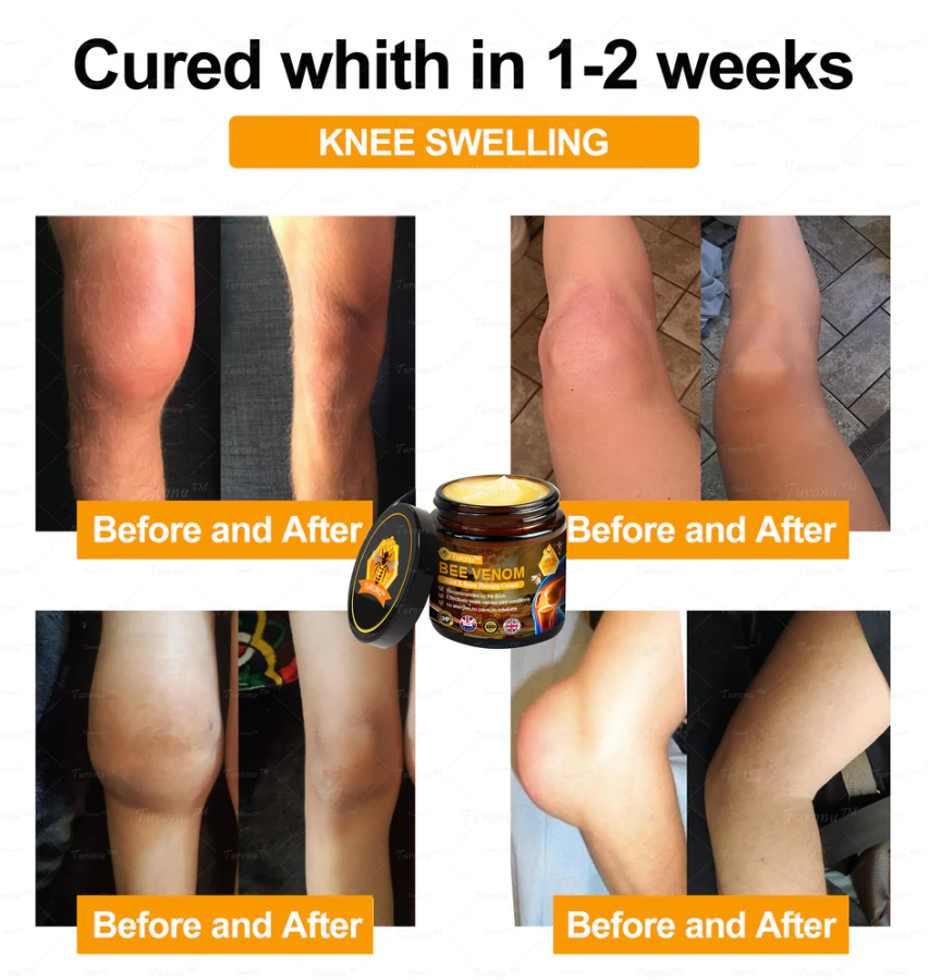✅Official Store: Bee-Venom Pain-Relief Bone Healing Cream✅( BOA Approved)(🔥𝑳𝒂𝒔𝒕 𝒅𝒂𝒚 𝒑𝒓𝒐𝒎𝒐𝒕𝒊𝒐𝒏 50% 𝒐𝒇𝒇)🍀
