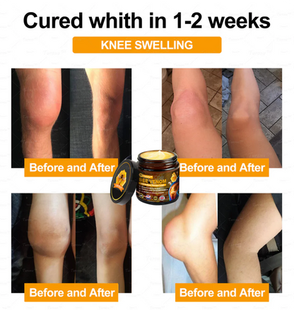 ✅Official Store: Bee-Venom Pain-Relief Bone Healing Cream✅( BOA Approved)(🔥𝑳𝒂𝒔𝒕 𝒅𝒂𝒚 𝒑𝒓𝒐𝒎𝒐𝒕𝒊𝒐𝒏 50% 𝒐𝒇𝒇)🍀