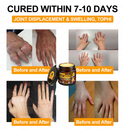 ✅Official Store: Bee-Venom Pain-Relief Bone Healing Cream✅( BOA Approved)(🔥𝑳𝒂𝒔𝒕 𝒅𝒂𝒚 𝒑𝒓𝒐𝒎𝒐𝒕𝒊𝒐𝒏 50% 𝒐𝒇𝒇)🍀