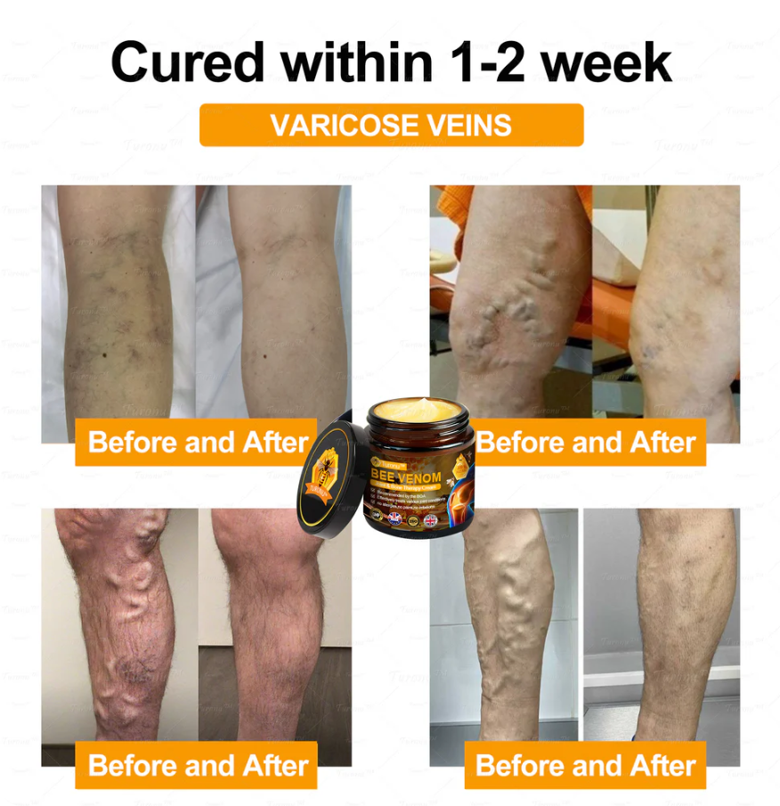 ✅Official Store: Bee-Venom Pain-Relief Bone Healing Cream✅( BOA Approved)(🔥𝑳𝒂𝒔𝒕 𝒅𝒂𝒚 𝒑𝒓𝒐𝒎𝒐𝒕𝒊𝒐𝒏 50% 𝒐𝒇𝒇)🍀