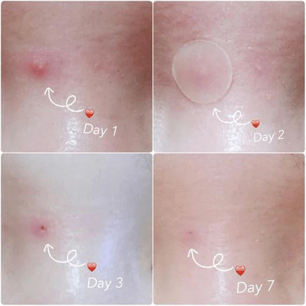 Skin Tag and Acne Master Patch (36 pcs)