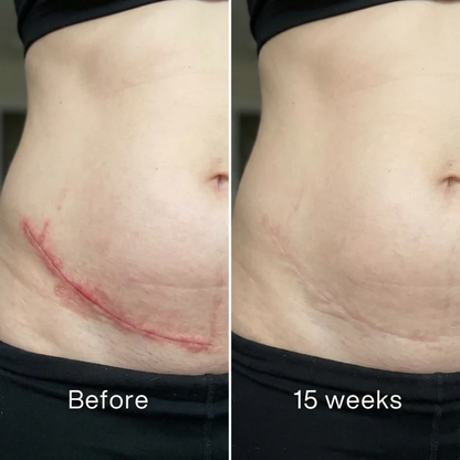 ODALIT™ Silicon ScarStick Limited Time 75%OFF Buy 2 Get 1 Free🔥LAST DAY⏰