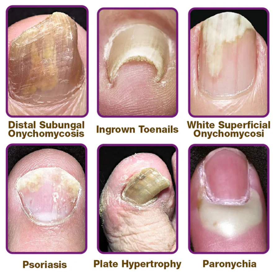 🐝BBOJI™ Fungus-Fres Bee poison Nail Treatment Serum