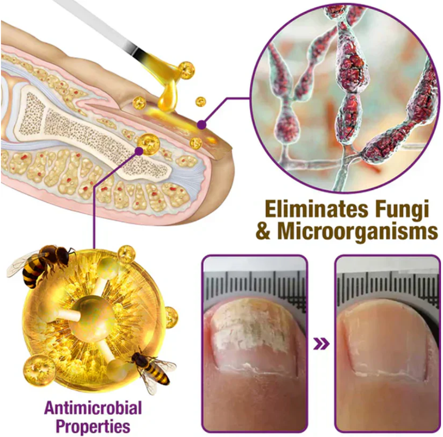 🐝BBOJI™ Fungus-Fres Bee poison Nail Treatment Serum