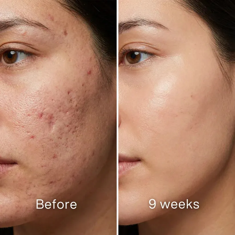 ODALIT™ Silicon ScarStick Limited Time 75%OFF Buy 2 Get 1 Free🔥LAST DAY⏰